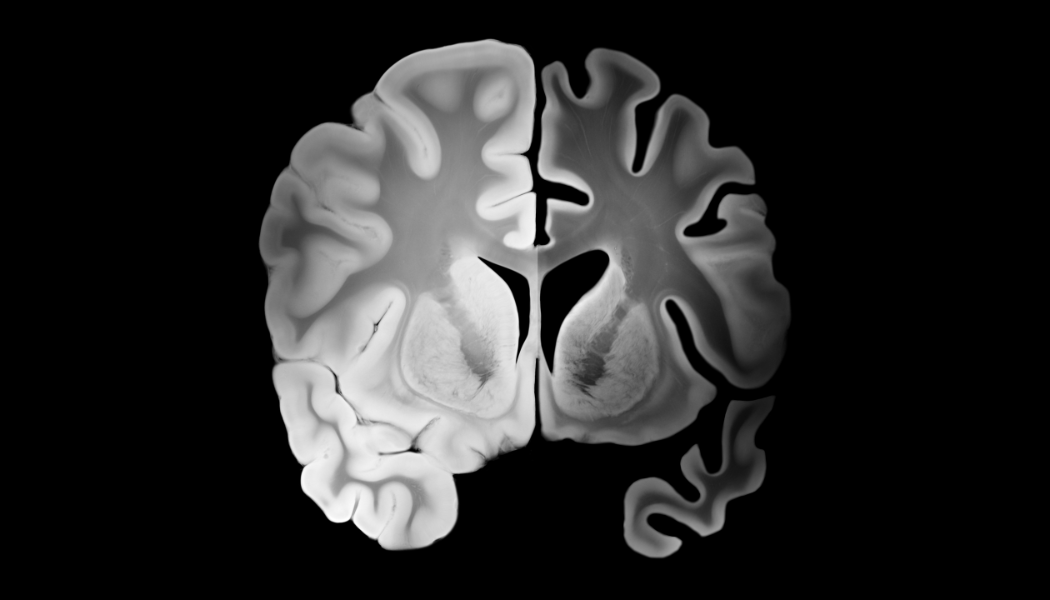 Brain Fog, Stress, and Cognitive Declne: What Your Nervous System Is Trying to Tell You